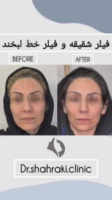 تزریق فیلر
