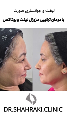 تزریق مزوژل و جوانساز