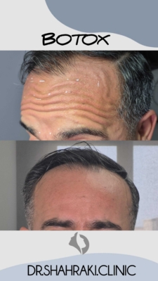 تزریق بوتاکس