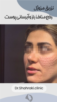 تزریق مزوژل و جوانساز
